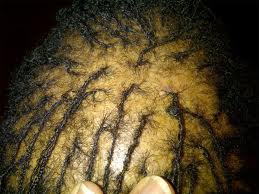 Micro braids are not the best choice if you want to avoid traction alopecia.